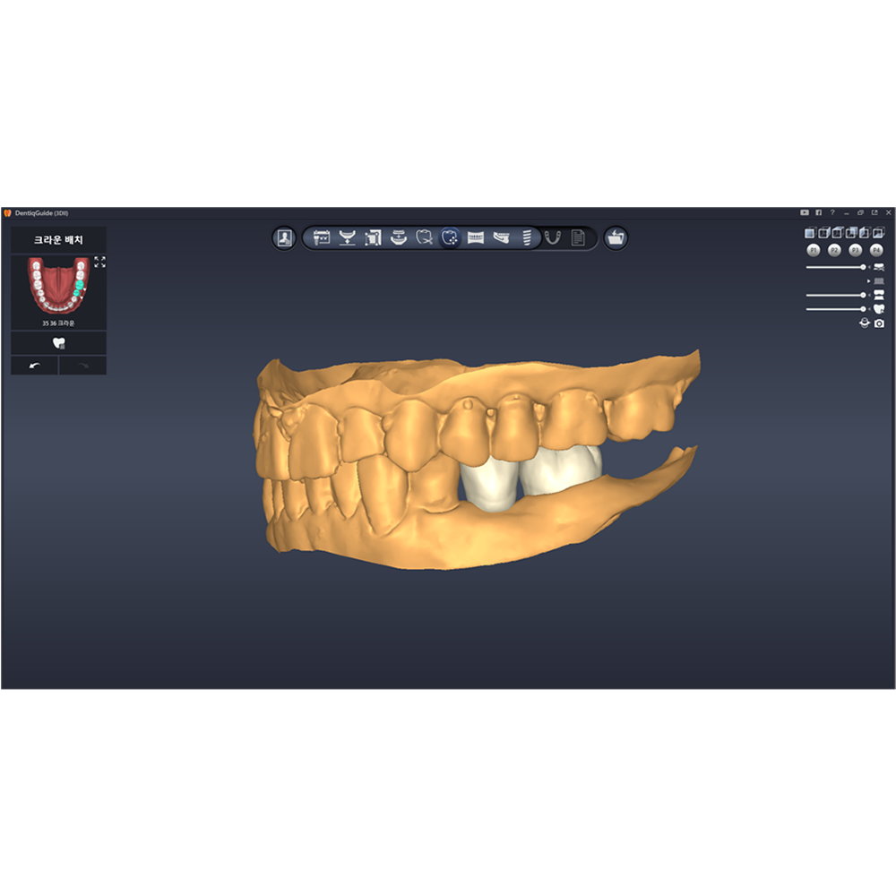 [3D Industrial] DentiqGuide